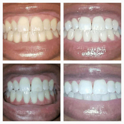 🔥Black Friday 90% OFF🔥SmileFitPro™ Teeth Whitening Pen
