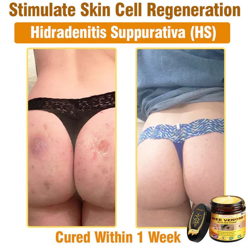 𝐋𝐎𝐕𝐈𝐋𝐃𝐒™ 𝐁𝐞𝐞 𝐕𝐞𝐧𝐨𝐦 𝐀𝐥𝐥-𝐢𝐧-𝐎𝐧𝐞 𝐂𝐫𝐞𝐚𝐦–🌸 Anti-aging,Hydrating, Skin Repair, Even Tone, Acne and Dark Spot Treatment, Wart and Mole Removal, Psoriasis Relief