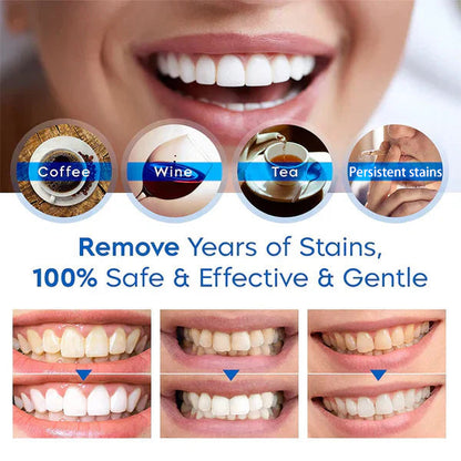 🔥Black Friday 90% OFF🔥SmileFitPro™ Teeth Whitening Pen