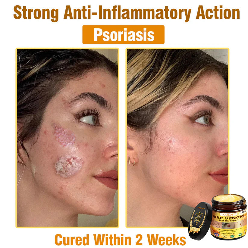 𝐋𝐎𝐕𝐈𝐋𝐃𝐒™ 𝐁𝐞𝐞 𝐕𝐞𝐧𝐨𝐦 𝐀𝐥𝐥-𝐢𝐧-𝐎𝐧𝐞 𝐂𝐫𝐞𝐚𝐦–🌸 Anti-aging,Hydrating, Skin Repair, Even Tone, Acne and Dark Spot Treatment, Wart and Mole Removal, Psoriasis Relief