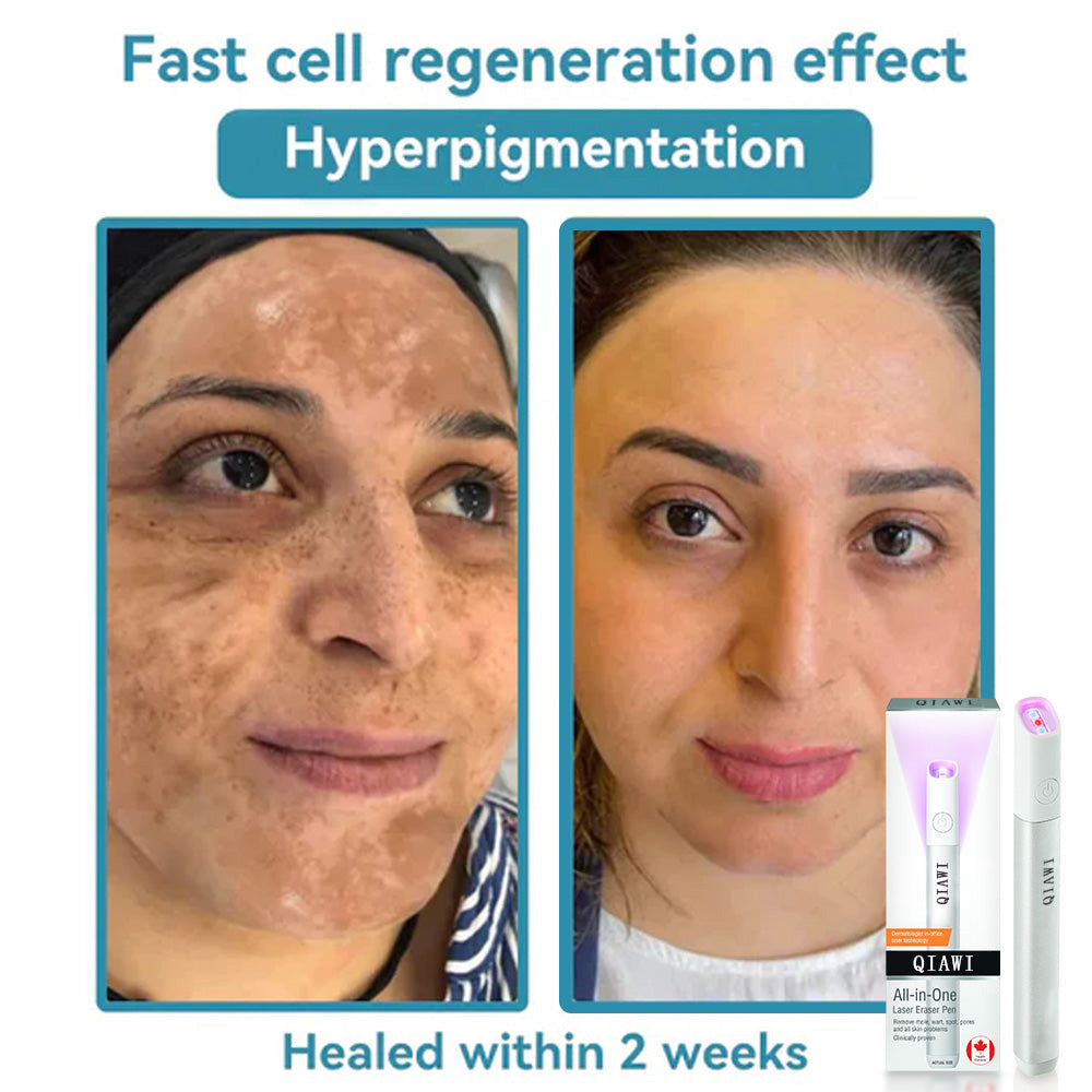 ✨QIAWI™ All-in-One CO₂ Laser Eraser Pen | Removes Moles, Warts, Skin Flaws & Pigmentation
