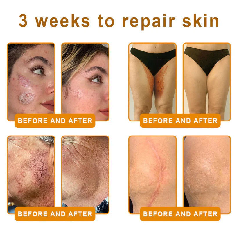 𝐋𝐎𝐕𝐈𝐋𝐃𝐒™ 𝐁𝐞𝐞 𝐕𝐞𝐧𝐨𝐦 𝐀𝐥𝐥-𝐢𝐧-𝐎𝐧𝐞 𝐂𝐫𝐞𝐚𝐦–🌸 Anti-aging,Hydrating, Skin Repair, Even Tone, Acne and Dark Spot Treatment, Wart and Mole Removal, Psoriasis Relief