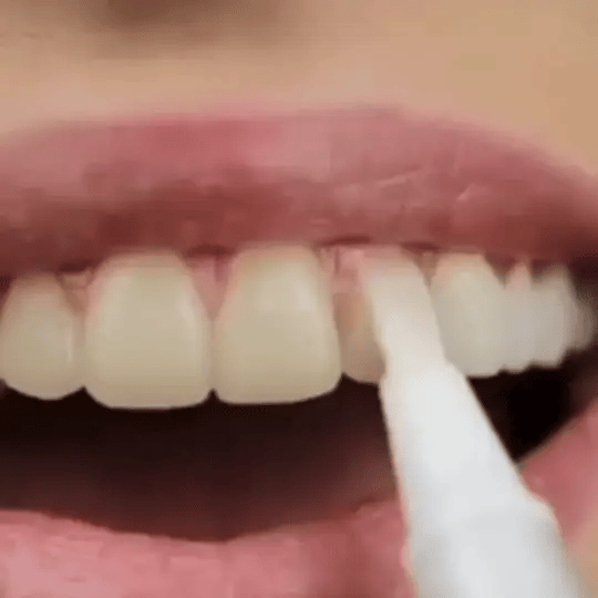 🔥Black Friday 90% OFF🔥SmileFitPro™ Teeth Whitening Pen