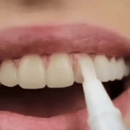 🔥Black Friday 90% OFF🔥SmileFitPro™ Teeth Whitening Pen